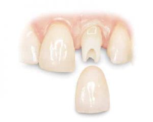 1 2 معرفی دندانسازی و انواع پروتزهای دندانی پروتز دندان به دندان مصنوعی یا تعویض دندان می گویند که در ادامه درباره آن توضیحات مفیدی را ارائه کرده ایم پس با ما همراه شوید .