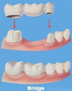 raveshhayejaygozin3 معرفی دندانسازی و انواع پروتزهای دندانی پروتز دندان به دندان مصنوعی یا تعویض دندان می گویند که در ادامه درباره آن توضیحات مفیدی را ارائه کرده ایم پس با ما همراه شوید .